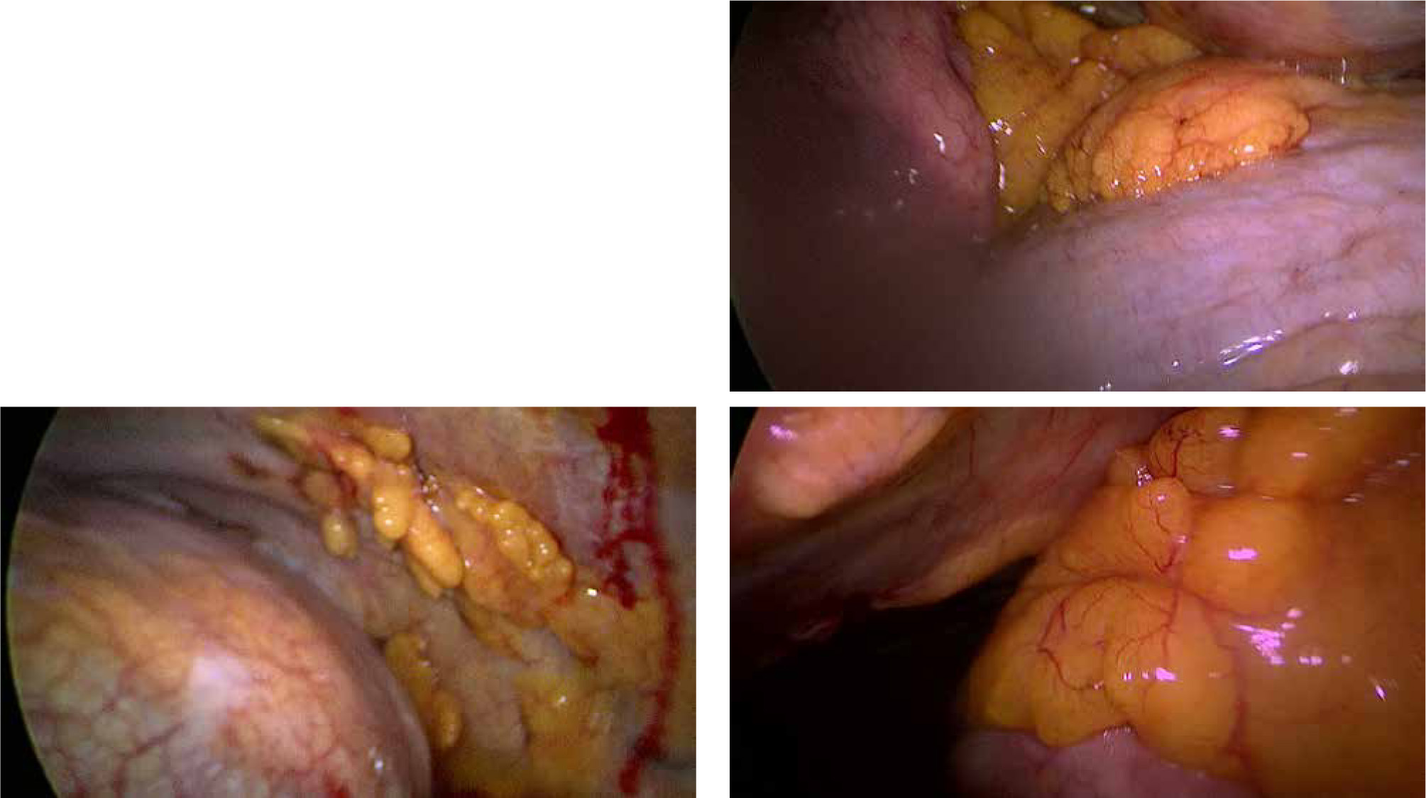 Figures 1-3 Images of the parietal pleura which appeared covered, on the whole surface, by islands of adipose tissue, without macroscopic pathological aspects.