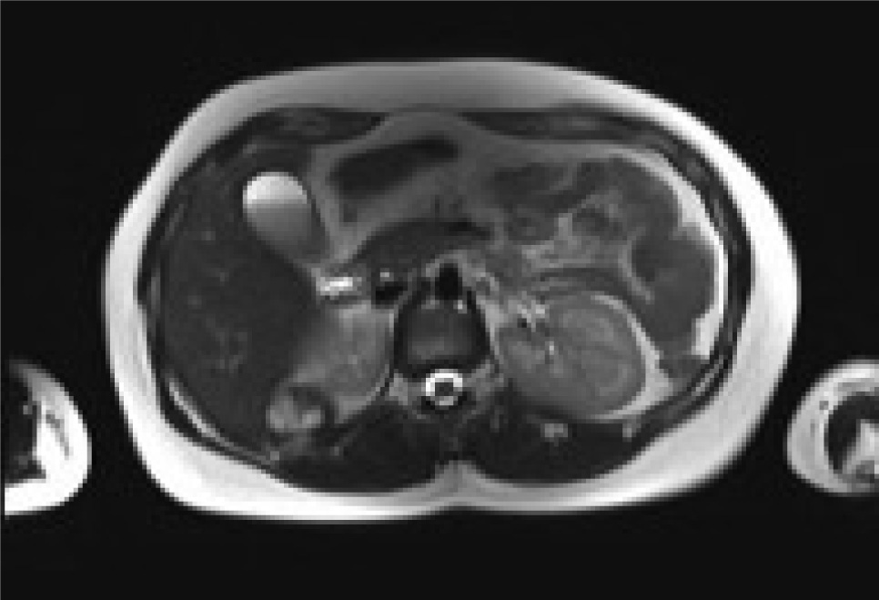 Figure 1 Rm scan T1weighted axial image showing the adrenal mass