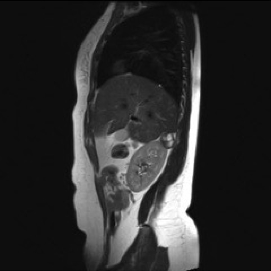 Figure 2 Rm scan T1weighted sagittal image showing the adrenal mass