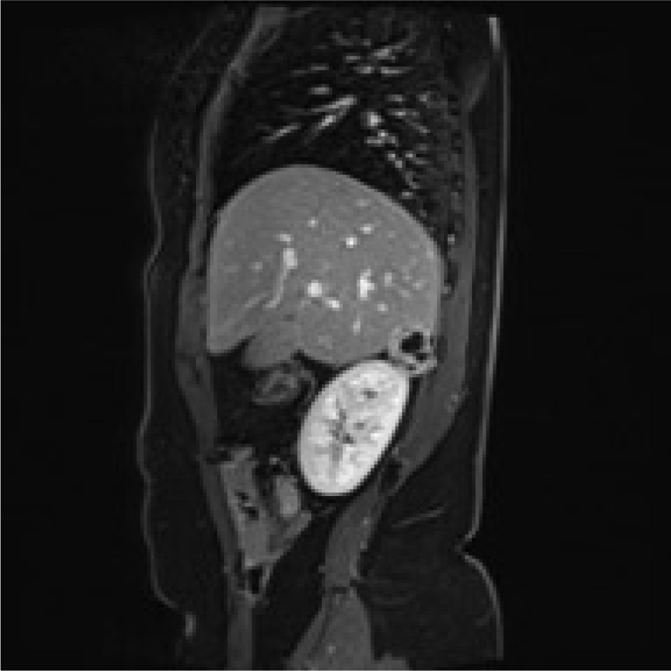 Figure 3 Rm scan T2weighted sagittal image showing the adrenal mass