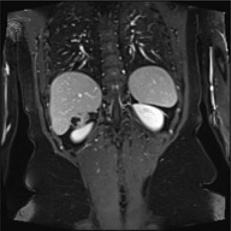 Figure 4 Rm scan T2 weighted coronal image showing the adrenal mass