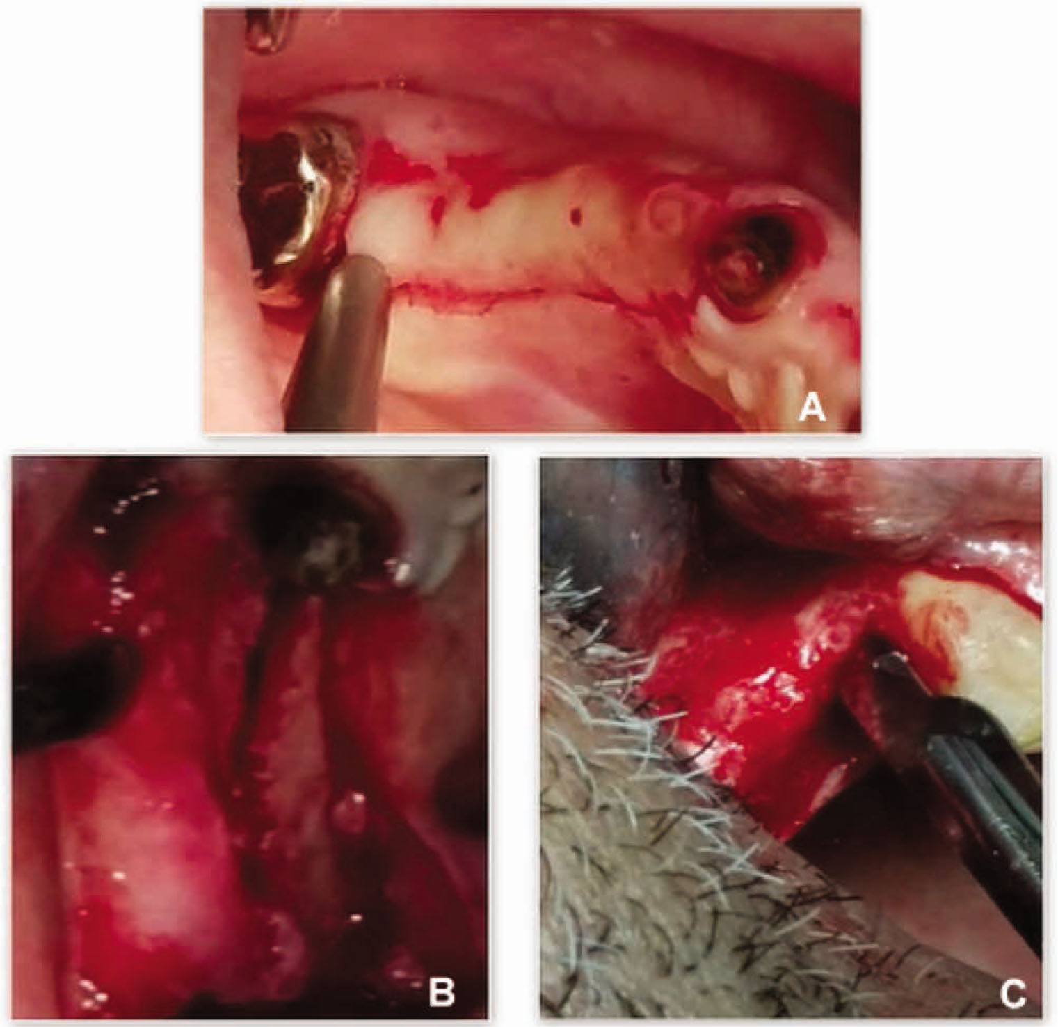 Figure 1 Clinical view of the initial surgical steps performed in one patient treated with the new flapless split crest procedure combined with PRF.A: View of the crestal mucosa incision shifted toward the palatal/lingual side to avoid positioning of the mucosa incision at the same site of the osteotomy line;B: View of full thickness flap elevation up to the buccal border of the alveolar crest. No periosteum elevation was performed on the buccal side to preserve vascular supply;C: View of linear osteotomies performed on upper jaw up to 1 mm from adjacent teeth.