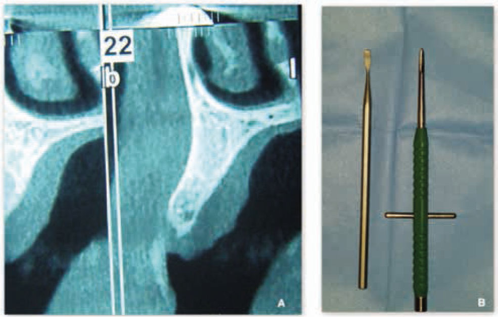 Figure 2 Double level implant site preparation.A: To obtain implant primary stability, a double level implant site preparation is performed: split crest is limited at the alveolar bone level by chisels;B: at the basal bone level site preparation is performed by implant kit burs up to 2.8mm diameter, followed by round osteotomes or round burs up to 3.5mm to avoid cortical wall damage.