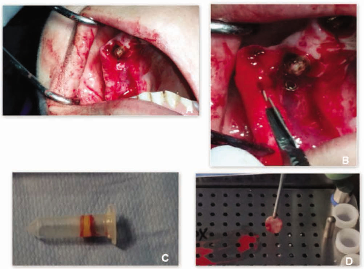 Figure 3 Clinical view of surgical steps performed in one patient treated with the new flapless split crest procedure combined with PRF.A: To obtain expanded bone stability osteotomy gaps were filled by autologous PRF and bone substitute to combine regenerative technique with split crest;B: To obtain primary closure of the wound, releasing incision was performed at the crestal mucosa level to gain sufficient lengthening for primary closure;C: Blood samples were collected into an 8.5 ml tubes without any anticoagulant, and immediately centrifuged;D: After centrifugation PRF was obtained from the middle of the tube.