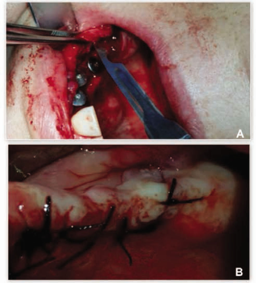 Figure 4 Clinical view of the final surgical steps performed in one patient treated with the new flapless split crest procedure combined with PRF.A: Implant insertion and flap release incision;B: Primary closure of the flap