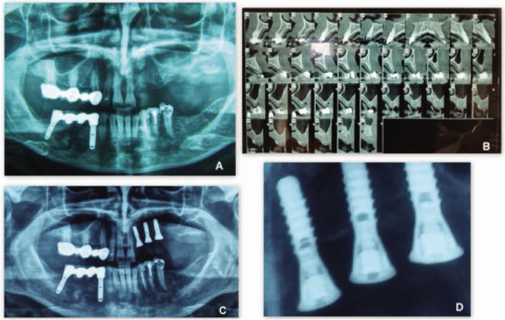 Figure 5 Radiographic views of a patient treated with the new flapless split crest procedure combined with PRF.A: Pre-operative X-Ray Orthopantomography;B: Pre-operative CT-Dentascan;C: Post-operative X-Ray Orthopantomography;D: 6 months post operative detail X-Ray image of the bone level at T3.