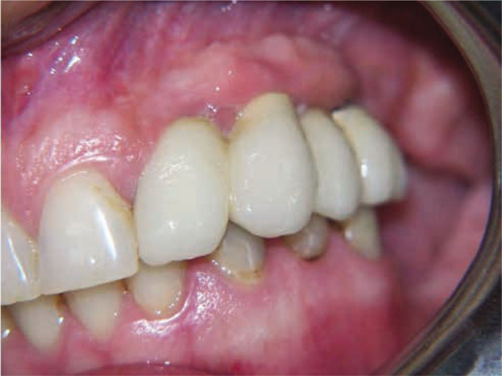 Figure 6 Final result and clinical oral view of a patient treated with the new flapless split crest procedure combined with PRF. Final aesthetic result obtained without any additional graft.