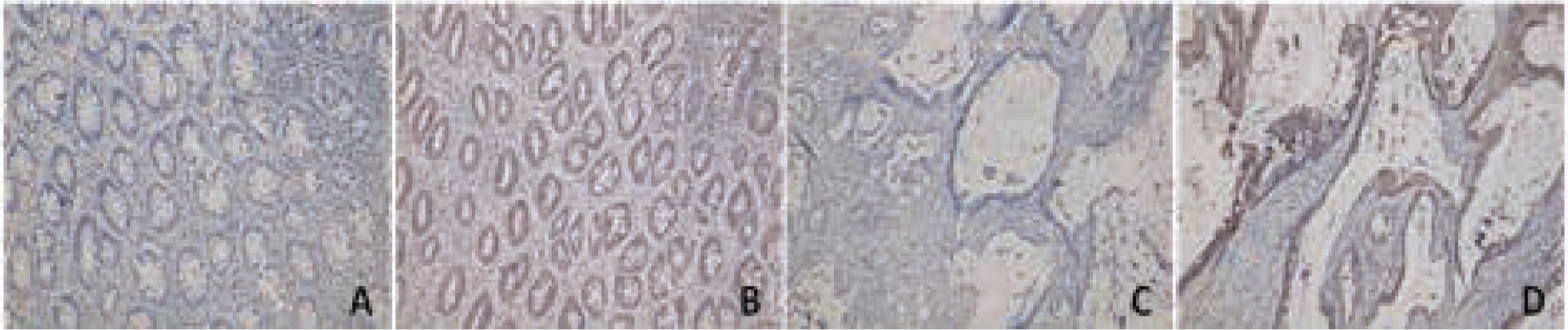 Figure 1 Galectin-3 expression in colorectal cancer tissue and normal intestinal tissues by immunohistochemistry(A: galectin-3 negative expression in normal intestinal tissues, × 200; B: galectin-3 positive expression in normal intestinal tissues, × 200; C: galectin-3 negative expression in colorectal cancer tissues, × 400; D: galectin-3 positive expression in colorectal cancer tissues, × 400)
