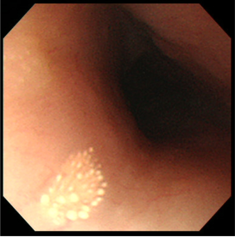 Figure 1 Endoscopic findings of esophageal xanthoma. A small yellowish granular lesion is noted in the esophageal mucosa
