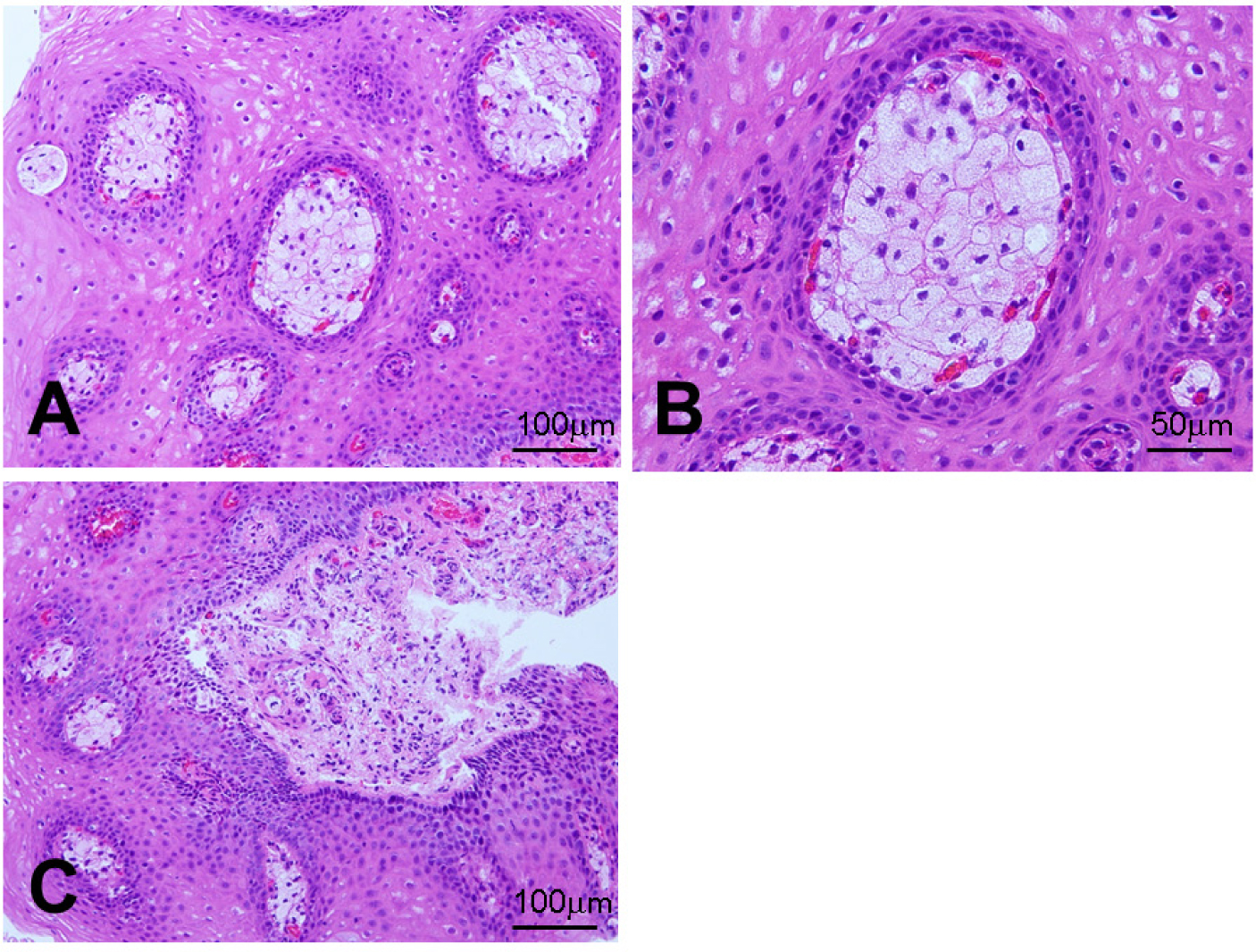 Esophageal xanthoma: presence of M2 macrophages suggests ..., image size:1406x1066