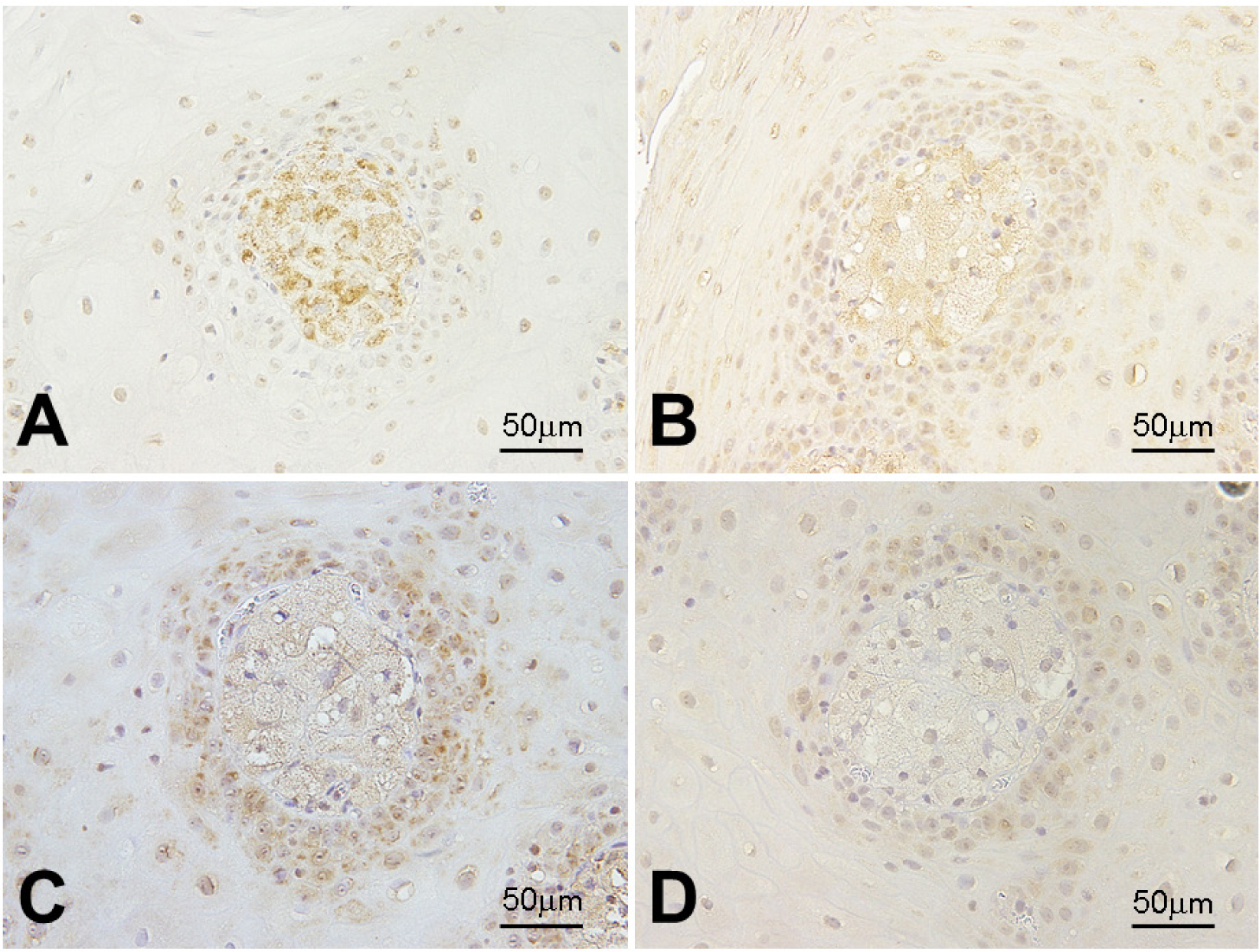 Figure 3 Expression of macrophage lineage markers in foam cells. Foam cells in xanthoma are strongly positive for CD68 (A, x400), moderately positive for CD163 (B, x400) and TGF-β (C, x400), and weakly positive for iNOS (D, x400)