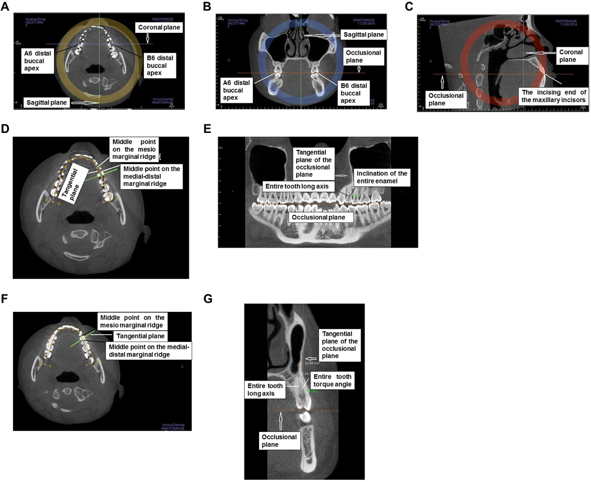 Figure 1 Adjustment of the base position for the craniofacial metrics plane. (A) Axial plane. (B) Coronal plane. (C) Sagittal plane. (D) Determination of the tangential plane on the measured tooth. (E) Measurement of the coronal axial inclination in the entire tooth mesiodistal transverse plane. (F) Determination of the tangential plane on the measured tooth. (G) Measurement of the coronal torque angle in the entire tooth buccal (labial) lingual transversal plane.
