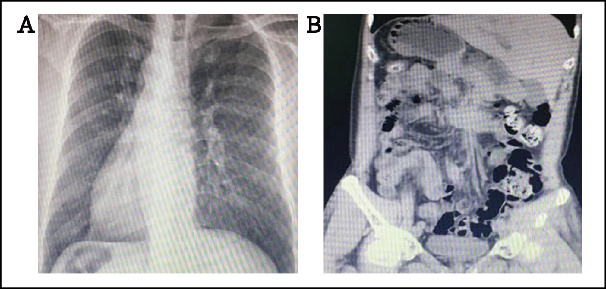 Figure 1 (A) Chest X-ray showing dextrocardia with a right aortic arch, right-sided stomach air bubble; (B) coronal CT scan showing the complete situs inversus. CT: computed tomography.