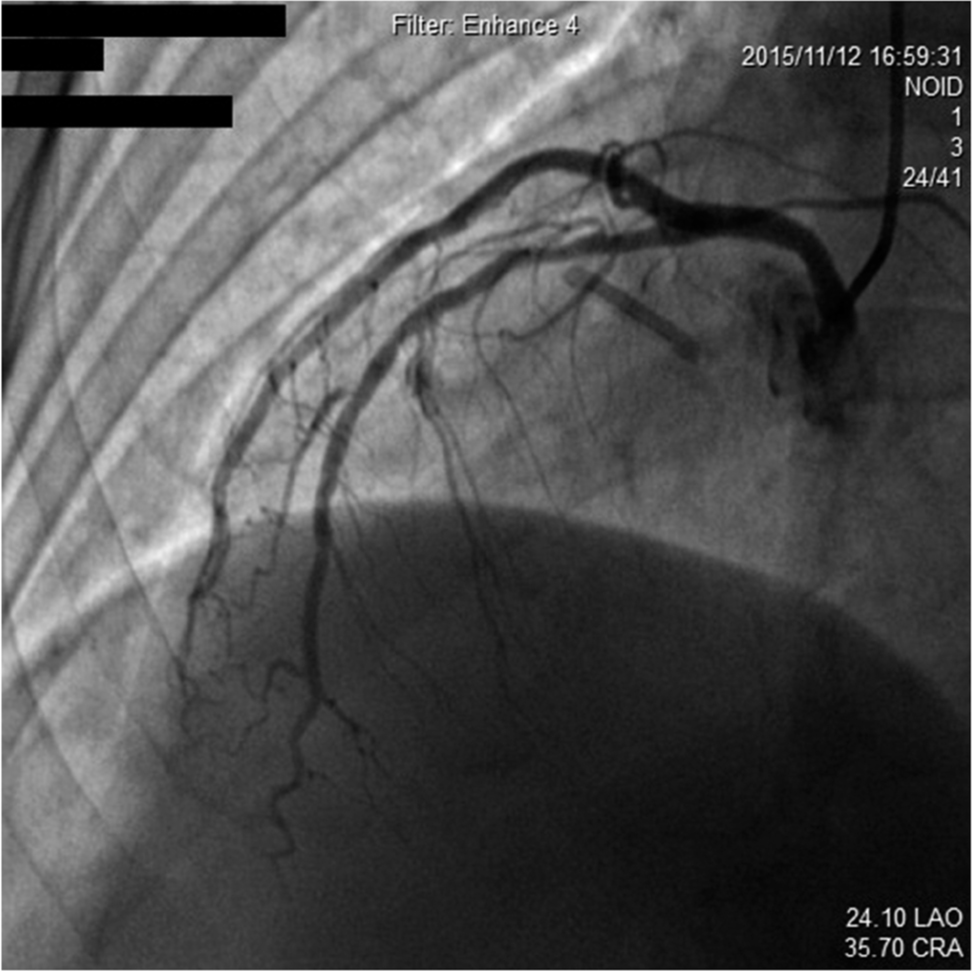 Figure 2 Coronary angiography showing no lesion in LAD.