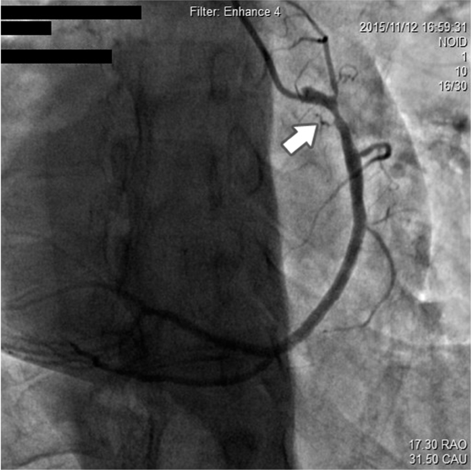 Figure 3 RCA showing nearly 80% of proximal segment stenosis.
