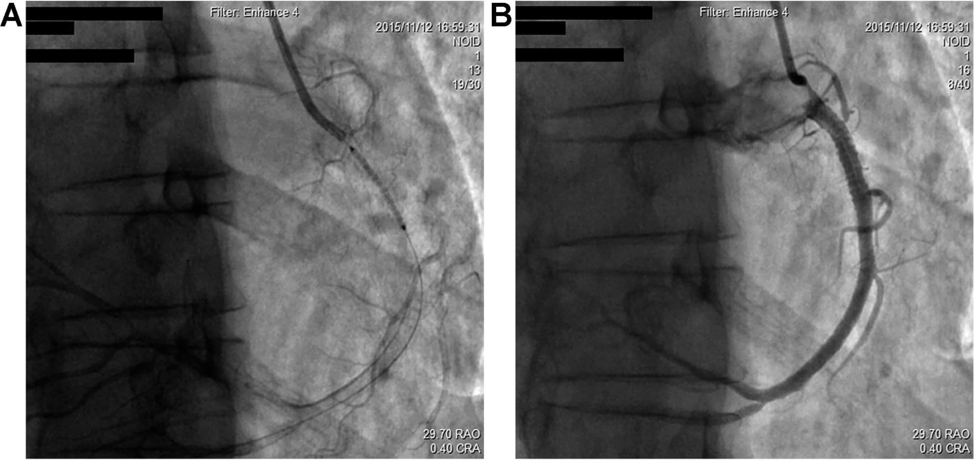 Figure 4 A drug-eluting stent was subsequently implanted at the lesion site and the intervention achieved optimal antegrade TIMI III flow without residual stenosis.