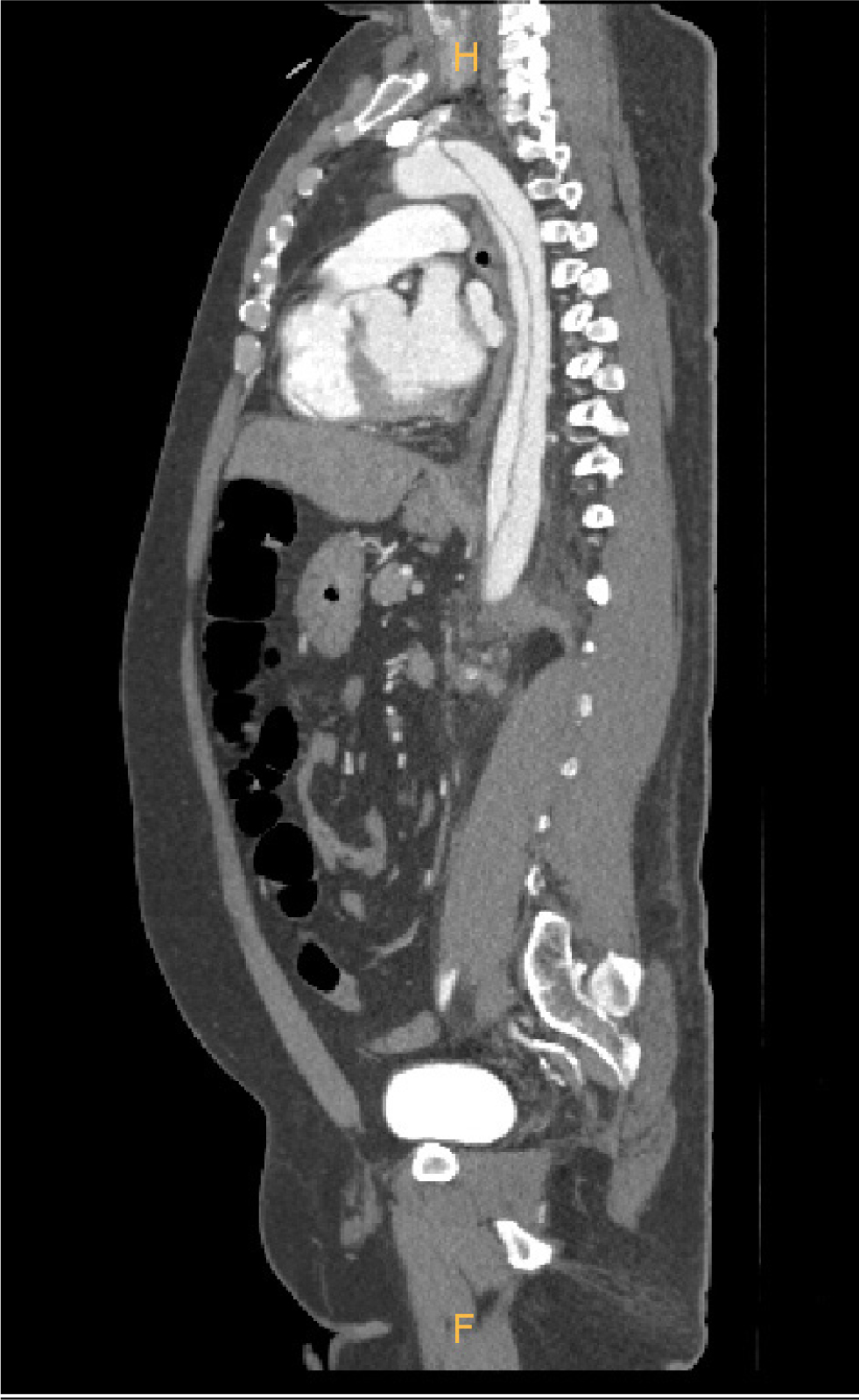 Figure 2 Contrast-enhanced computed tomography scan showing Stanford type B aortic dissection.