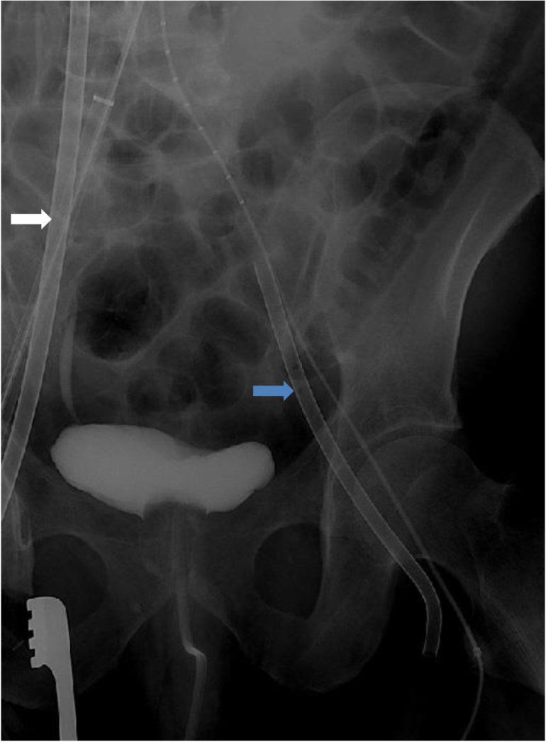 Figure 4 Venous cannulations for extracorporeal life support under fluoroscopic guidance. A 21 French venous cannula was inserted into the right common femoral vein for venous drainage (white arrow). A 17 French arterial cannula was inserted into the left common femoral vein for return (blue arrow).