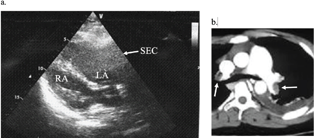 Figure 1 a. A transesophageal echocardiogram, in which the transthoracic echocardiogram view shows significant spontaneous echo contrast (SEC) in the left atrium (LA) (arrow), compared with the right atrium (RA); this predicts formation of thrombus.
b. Thrombus was observed on both sides of the pulmonary artery (arrow) with contrast-enhanced computed tomography.