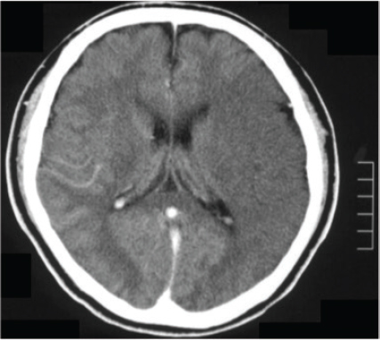 Figure 2 A low-density area indicating brain infarction in the left middle cerebral artery area was observed on brain computed tomography upon entering the operating room.