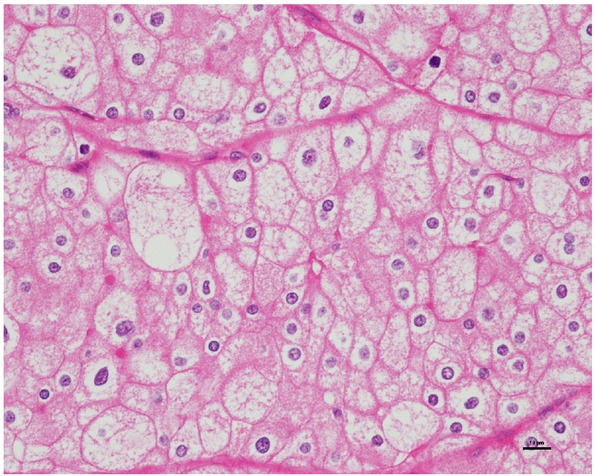 Figure 1 Classical chromophobe renal cell carcinoma pattern with wide constitutive nuclear range, without nuclear crowding and anaplasia (400x), CTG 1, FNG 3