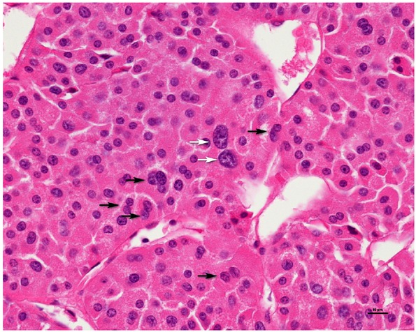 Figure 2 Nuclear crowding (black arrow) with pleomorphism (white arrow, three-fold variation in nuclear size and distinct nuclear chromatin irregularities) (400x), CTG 2, FNG 3