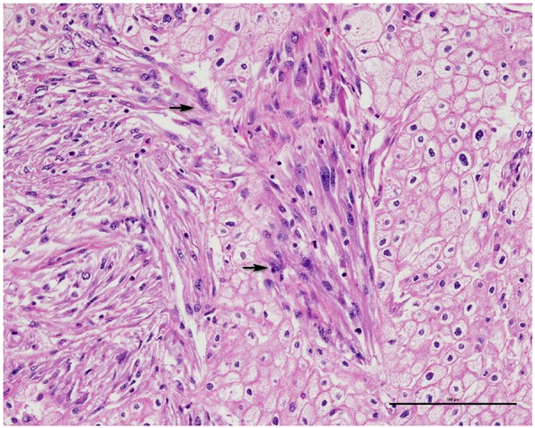 Figure 3 Tumor cells with sarcomatoid change (black arrow) (200x), CTG 3, FNG 4