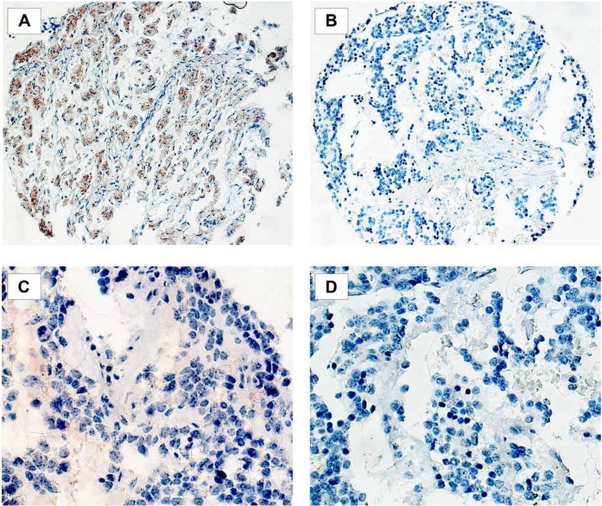 Figure 1 Expression of CHL1 and NrCAM in pediatric neuroblastoma. Representative examples of CHL1 positive (A) and CHL-1 negative (B) (magnification x100) as well as NrCAM positive (C) and NrCAM negative (D) immunostaining (magnification x200).