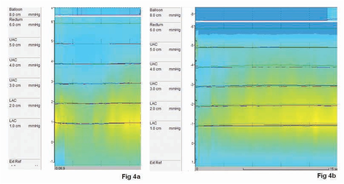 Figure 4 Pre FMS treatment (a) and post FSM treatment (b) HRAM (High Resolution Anal Manometry) showing no significant sphincteral improvement