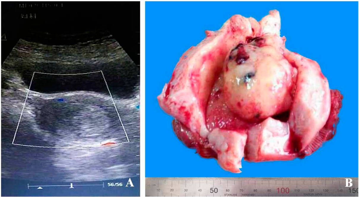Figure 1 Imaging and gross feature of the case. A) Ultrasound images showing that the uterine cavity was occupied by an oval shaped mass. B) The gross appearance of the brown polypoid tumor located in the uterine cavity and originated from the endometrium.