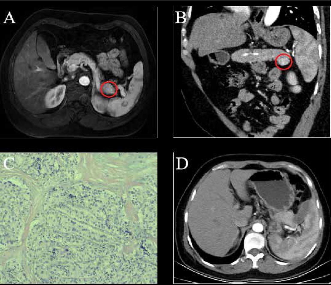 Figure 1 A 44-year-old female with pathology-proven pancreatic insulinoma was treated with laparoscopic RFA. (A) Contrast-enhanced MRI showed a round-like, well-defined lesion in the pancreatic tail in the arterial phase (red cycle). (B) Coronal reconstructed CT image showed the tumor grew in an exophytic pattern (red cycle). (C) Pathology confirmed the diagnosis of pancreatic insulinoma (HE×100). (D) Contrast-enhanced CT showed no residual tumor foci and recurrent lesion with a small volume of fluid collection near the pancreatic tail.