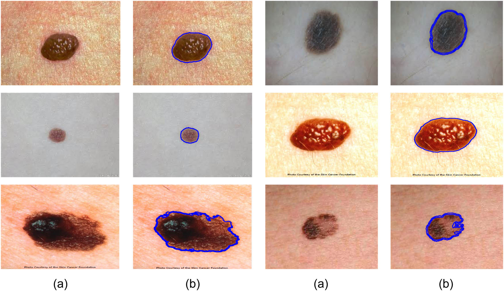 Figure 4 The results of cancer diagnosis for some examples by the SBO-based CNN. (a) before process, (b) after process.