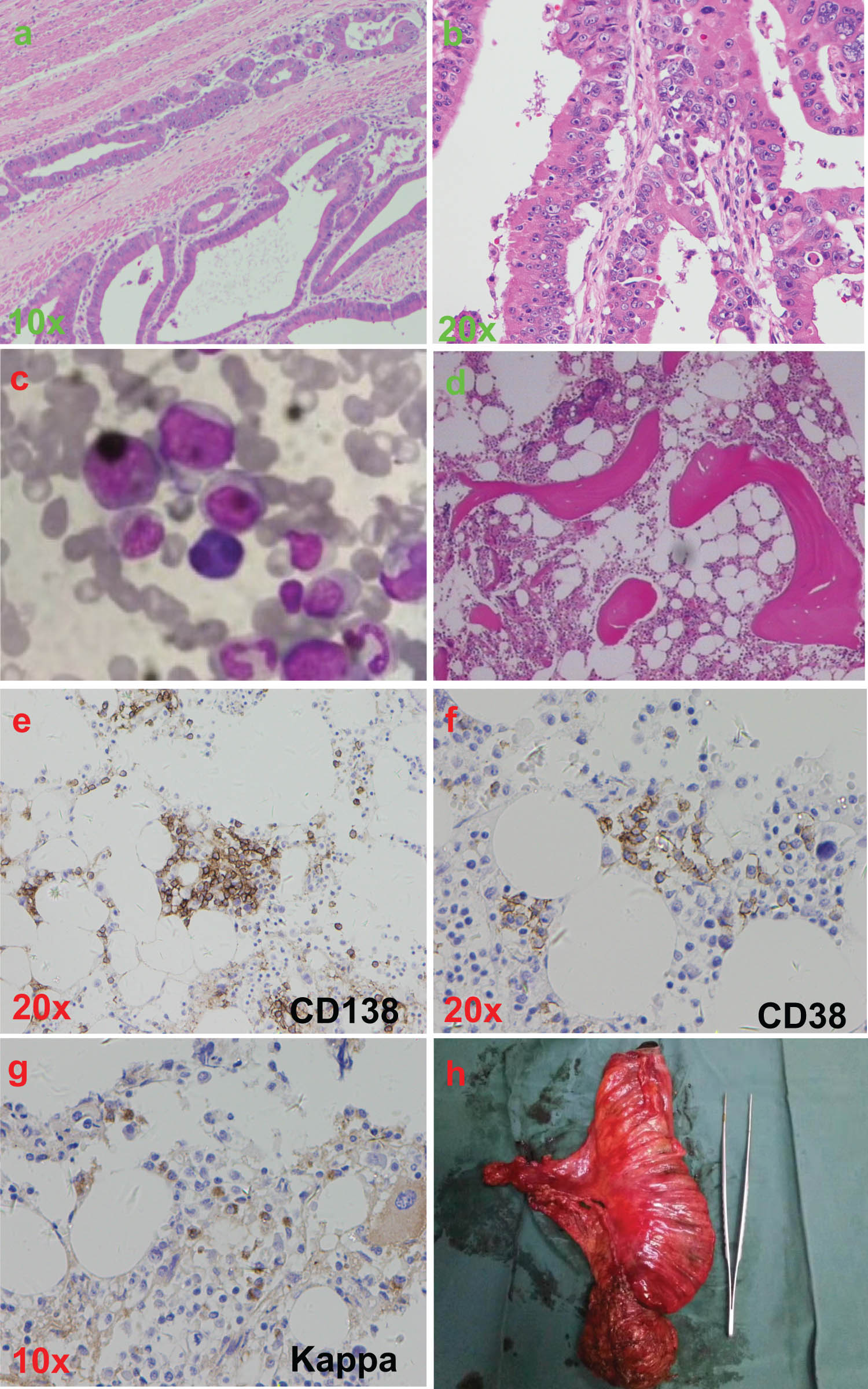 Figure 1 Clinical and histopathological appearances. (a and b) HE staining results from thickened rectum showing adenocarcinoma. (c) Bone marrow cytology results showing increased plasmocyte. (d–g) Pathological and immunohistochemical results of bone marrow showing CD138 (+), CD38 (+), CD56 (partial +), Kappa (+), myelodysplastic activity and increased plasmocyte. (h) Excised rectal cancer.