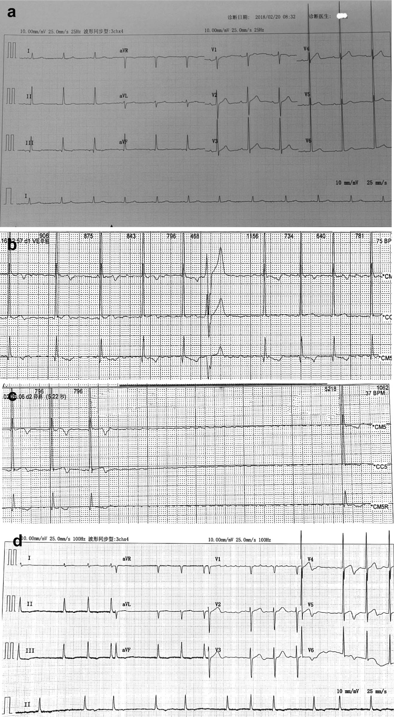 Figure 2 ECG of patient during treatment. (a) Normal ECG before atrial fibrillation and RR interval prolongation; (b) the first holt result showing atrial fibrillation occurring during thalidomide treatment; (c) the first holt result showing serious RR interval prolongation (RR interval = 5.2 s) during thalidomide treatment; and (d) atrial fibrillation did not disappear after withdrawal.