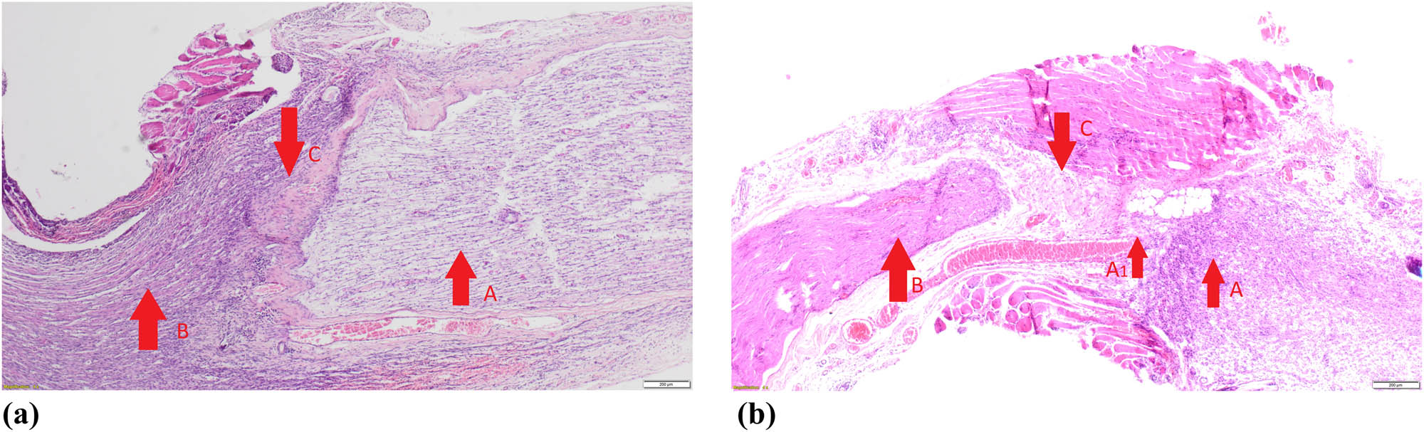 Figure 3 Pathomorphological examples of a side-to-side (a) and an end-to-end (b) nerve anastomoses.