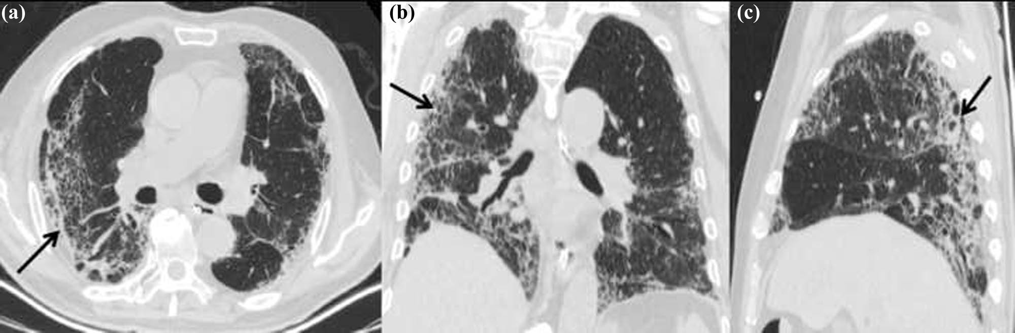 Figure 3 CT scans obtained 20 days after admission (a: axial non-contrast CT image; b: coronal thin-section non-contrast CT image; and c: sagittal thin-section noncontrast CT image) showing the range of lesions reduced significantly compared with previous images; fibrous changes in subpleural (black arrows).