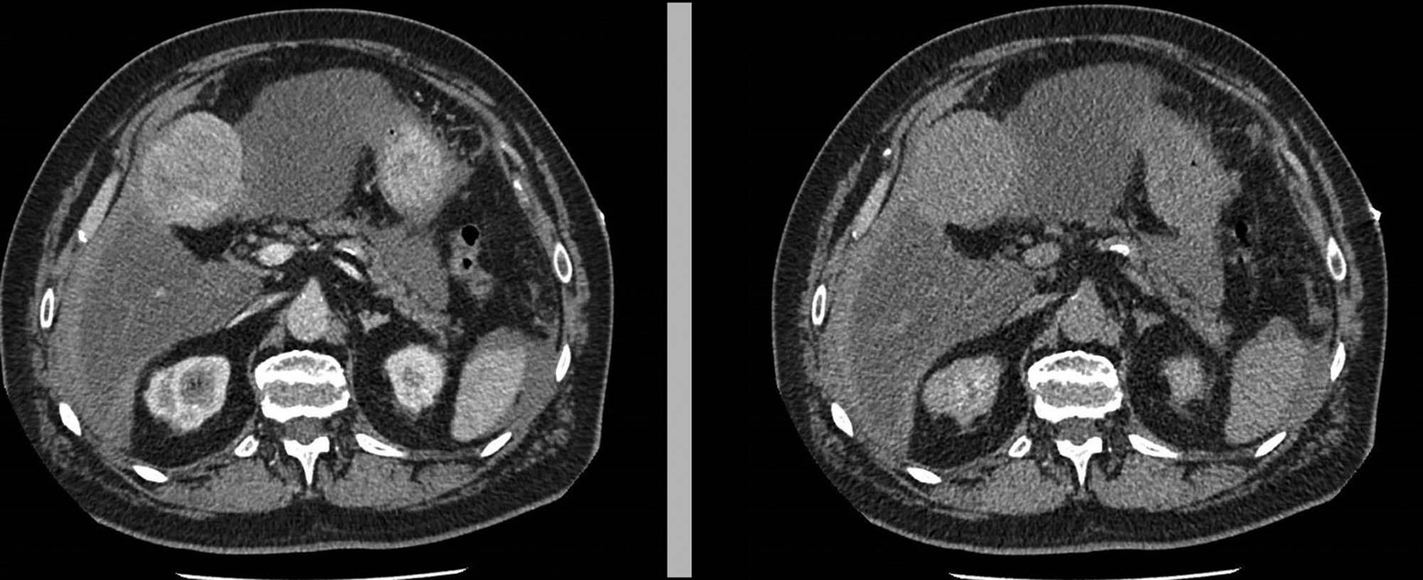 Figure 1 Neoformation of the IV hepatic segment.