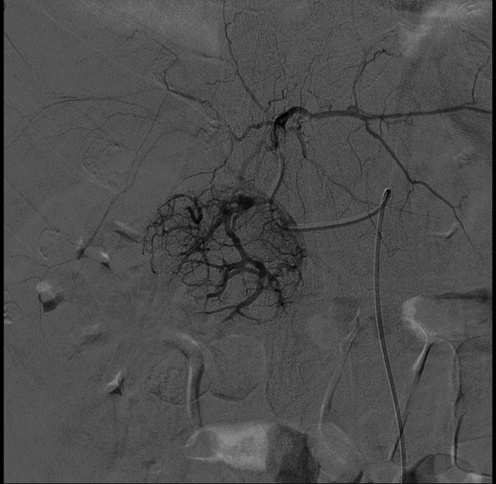 Figure 2 Expansive lesion of the IV hepatic segment.