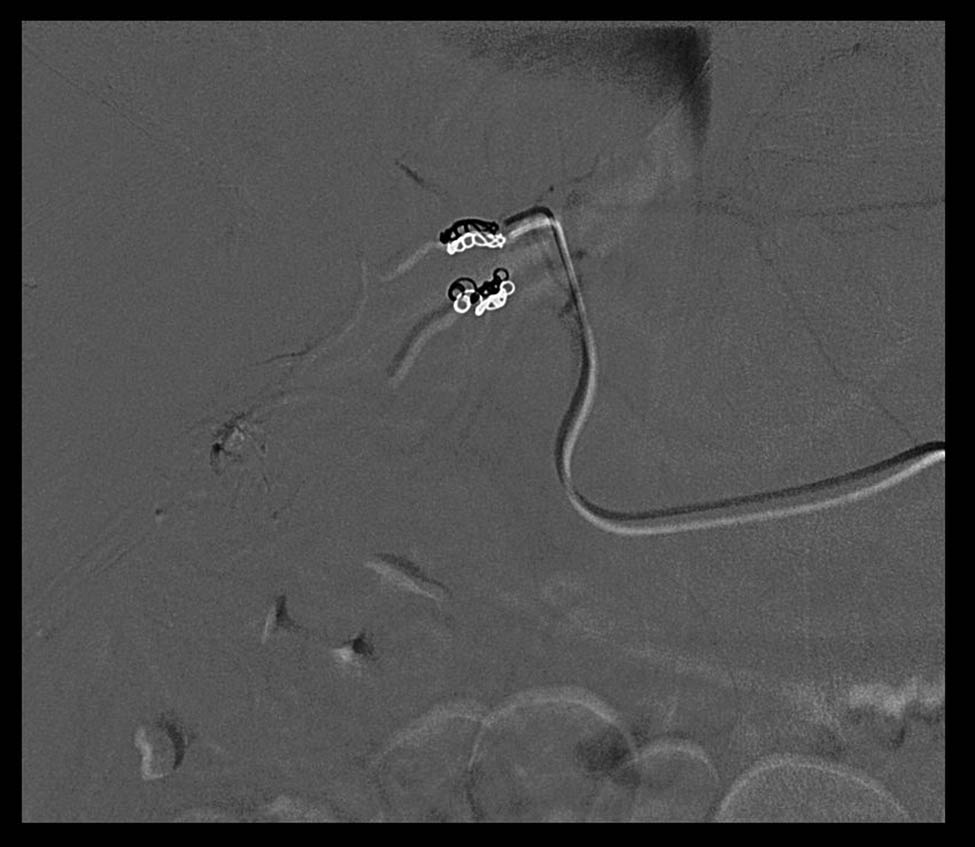 Figure 3 Metal microspirals and devascularizated lesion.