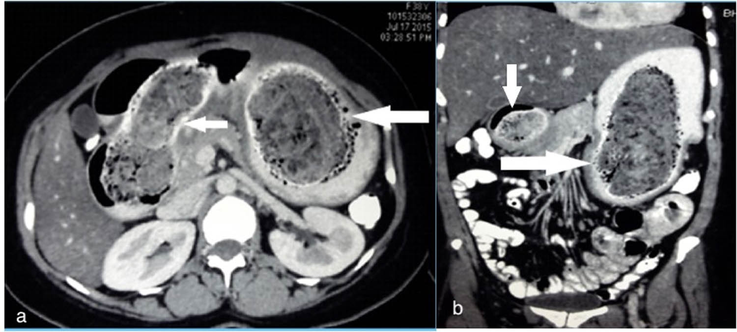 Figure 1 Axial (a) and coronal (b) CT scan image showing a non-homogenous non-enhancing mass with a mottled appearance within the lumen of the stomach (large arrow) first and second part of duodenum (small arrow).