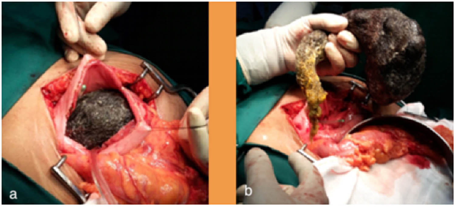 Figure 2 Panels (a and b) showing anterior gastrotomy and removal of the large trichobezoar extending from the stomach to the second part of duodenum