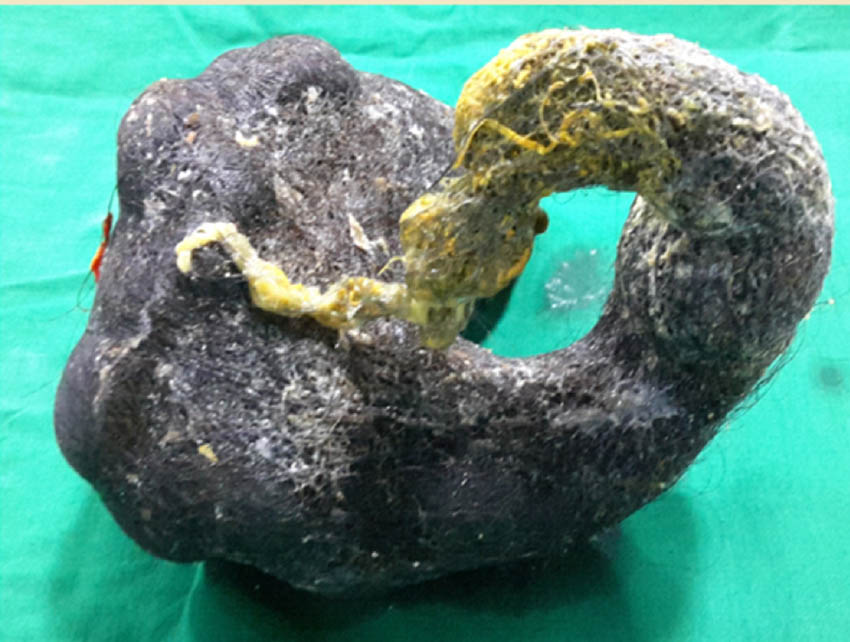 Figure 3 Specimen showing the removed trichobezoar casted in the shape of the stomach and the duodenum.