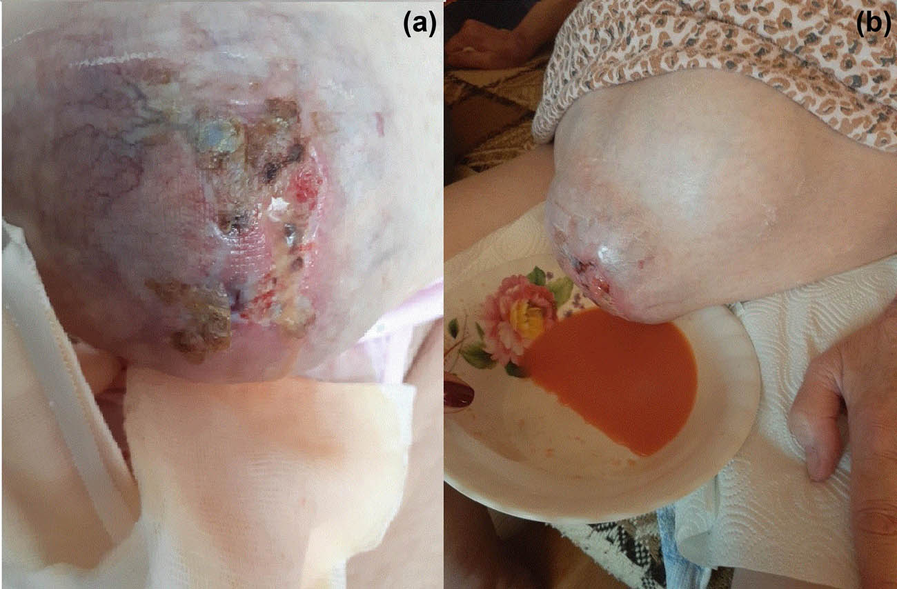 Figure 1 (a) Large metastatic lesion infiltrating peritoneum, omentum, fascia, subcutaneous tissue, and skin became visible due to increased ascites. (b) The cloudy orange fluid was leaking out under high pressure from the PCF.