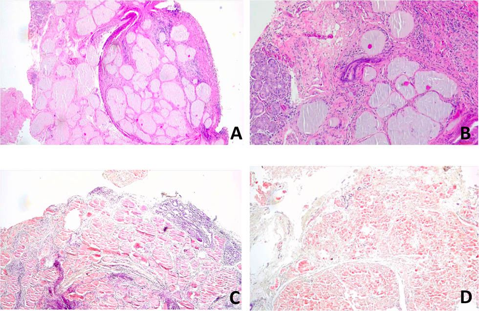Figure 1 Histological preparation. (A) Excisional biopsy of the left vocal cord reveals a deposit of amorphous eosinophilic material in the tissue, consisting of amyloid (hematoxylin–eosin stain). Magnification 4×. (B) Detailed image of amyloid deposits. Magnification 10×. (C and D) Deposits are highlighted on Congo red stain. Magnification 10×.