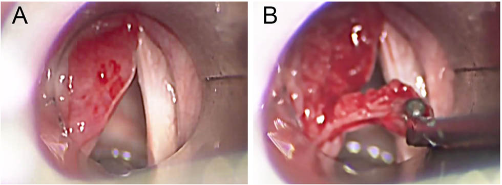 Figure 3 Intraoperative images: before (A) and during (B) the surgical excision.