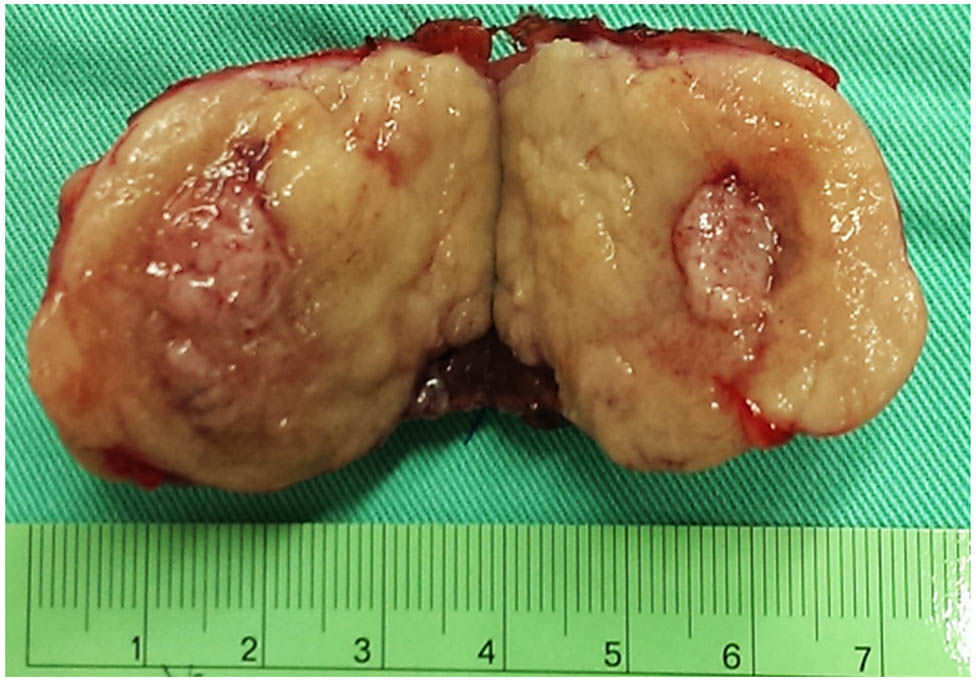 Figure 2 
               The specimen of the main renal tumor.
            