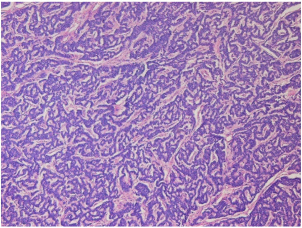 Figure 3 
               Microscopic findings of H&E staining showed that the tumor grew in a gyriform pattern with hyperchromatic nuclei. NET, neuroendocrine tumor.
            