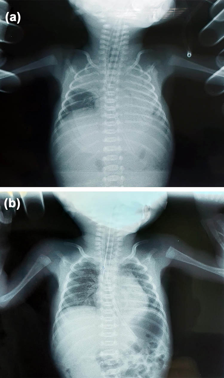 Figure 1 
               Chest X-ray of the newborns. (a) Image shows decreased transparency of the pulmonary parenchyma to the left with a clearly limited presence in the upper lobe area to the right in the first newborn; (b) chest X-ray shows individual paracardial and basal shadings of the pulmonary parenchyma in the second newborn.
            