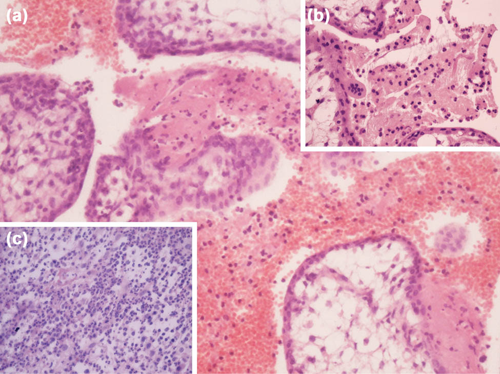 Figure 2 
               Histological features of chorioamnionitis caused by Serratia marcescens. Photomicrographs of the placental tissue show neutrophilic infiltrate of membranes and those overlying the chorionic plate with rare macrophages and without necrotic debris; (a) hematoxylin and eosin staining, ×200; (b) hematoxylin and eosin staining, ×400; (c) hematoxylin and eosin staining, ×400.
            