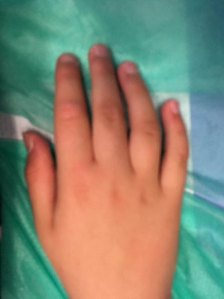 Figure 3 
               Small and short hands in girl with Cohen syndrome.
            